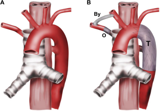 Dysphagia Lusoria Treatment