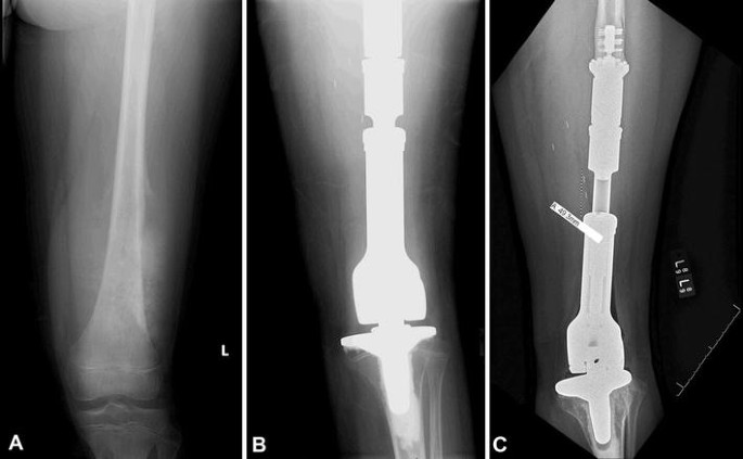 Intramedullary Osteosarcoma Therapeutics