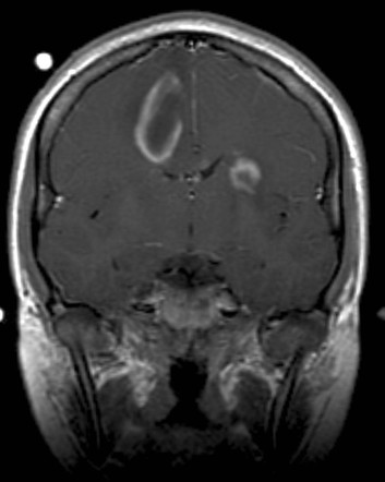 Acute Disseminated Demyelination Treatment