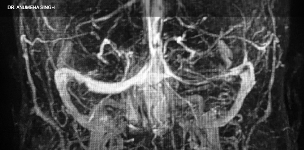 Cerebral Vein Thrombosis Treatment