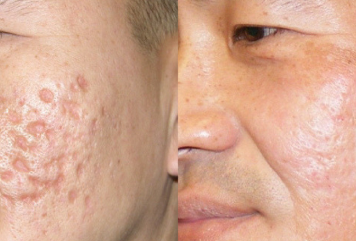 Acne Scar Treatment