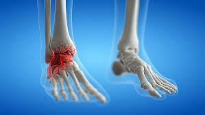 Ankle Arthritis Treatment