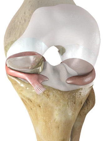 Artificial Meniscus