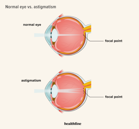 Astigmatism