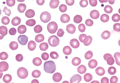 Autoimmune Hemolytic Anemia Therapeutics