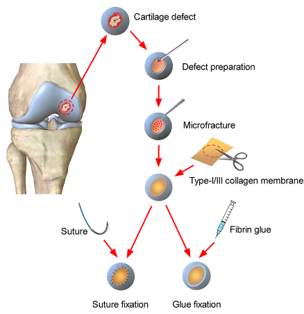 Autologous Matrixinduced Chondrogenesis