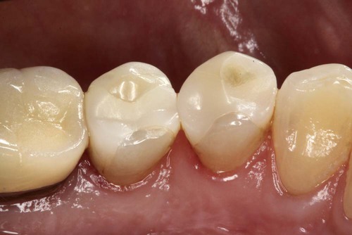 Zirconia Dental Indirect Restorations Material