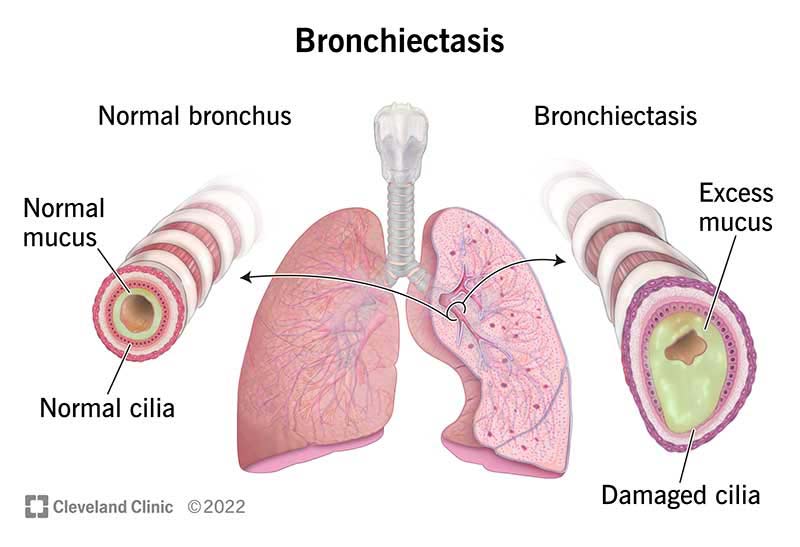 Bronchiectasis Therapeutic