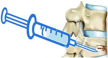 Injectable Bone Cement