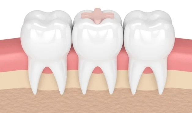 Glass Ionomer Dental Materials