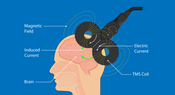 Transcranial Magnetic Stimulation Treatment