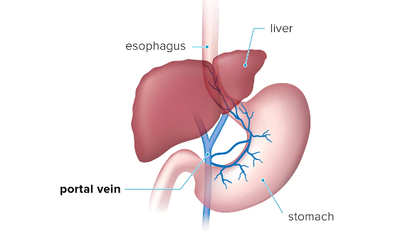 Portal Hypertension Treatment