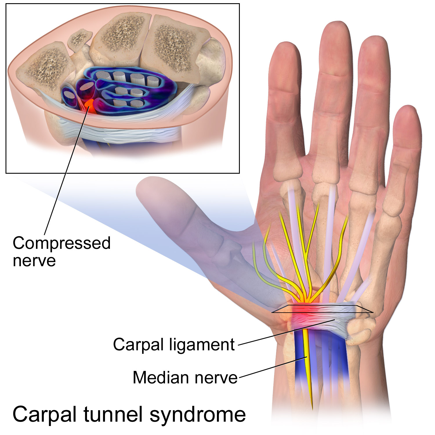 Carpal Tunnel Syndrome Treatment