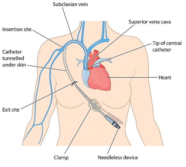 Catheter-Related Bloodstream Infections