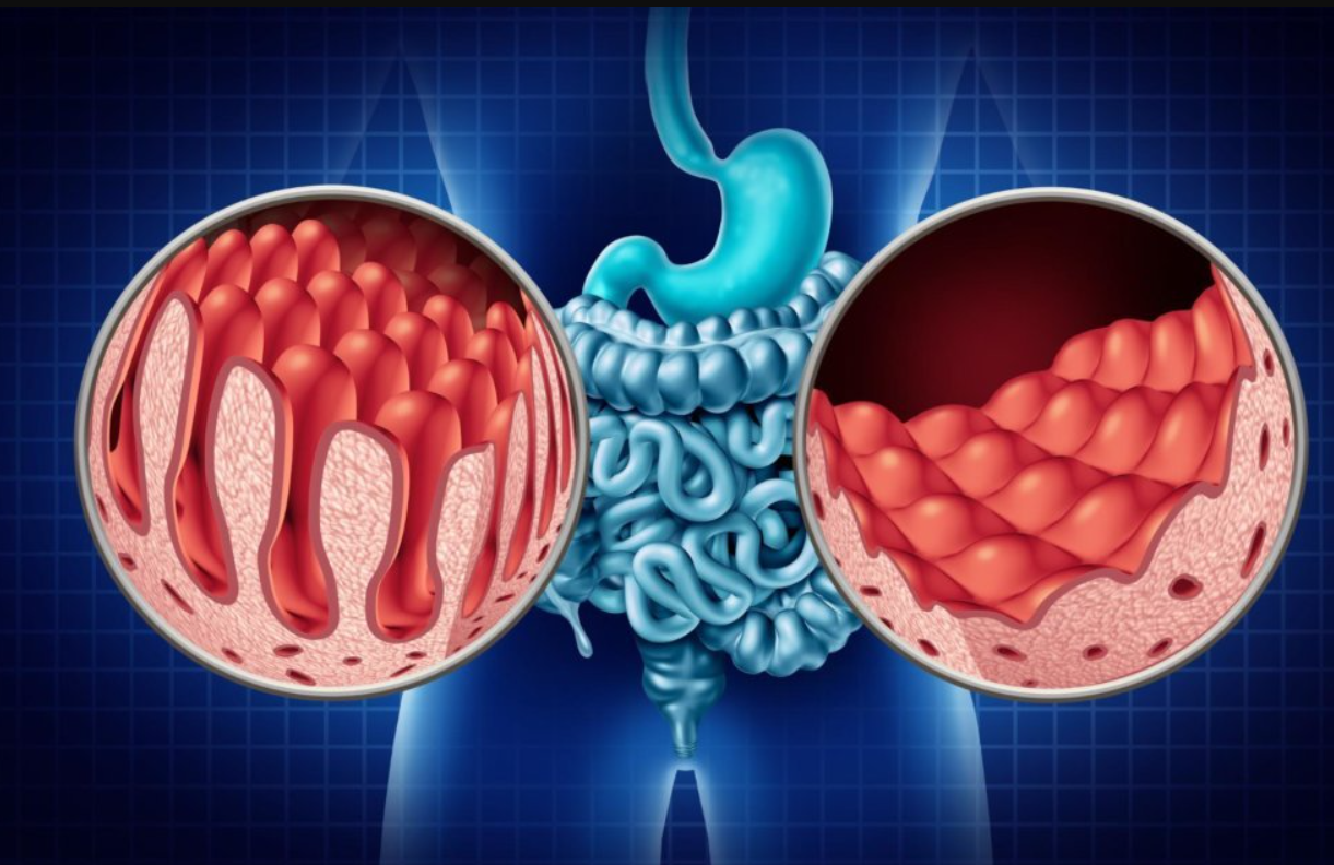 Celiac Disease Diagnostics