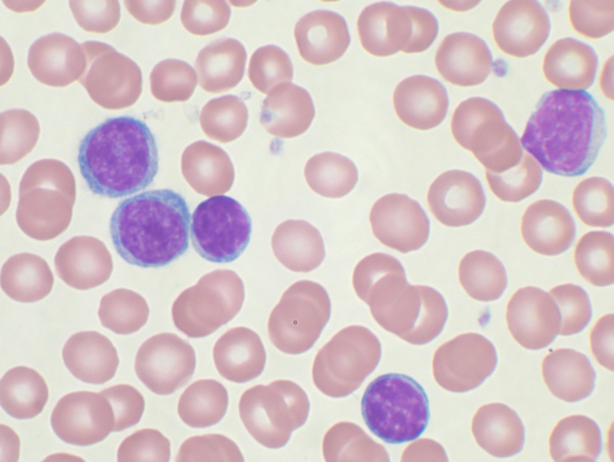 Small Lymphocytic Lymphoma Therapy