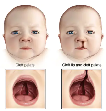 Cleft Lip Treatment