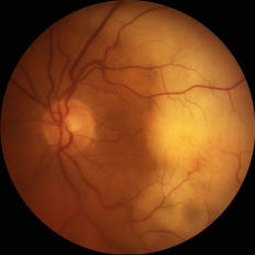 Intraocular Lymphoma Treatment