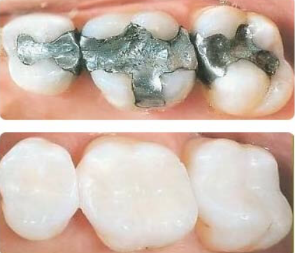 Dental Cavity Filling Material