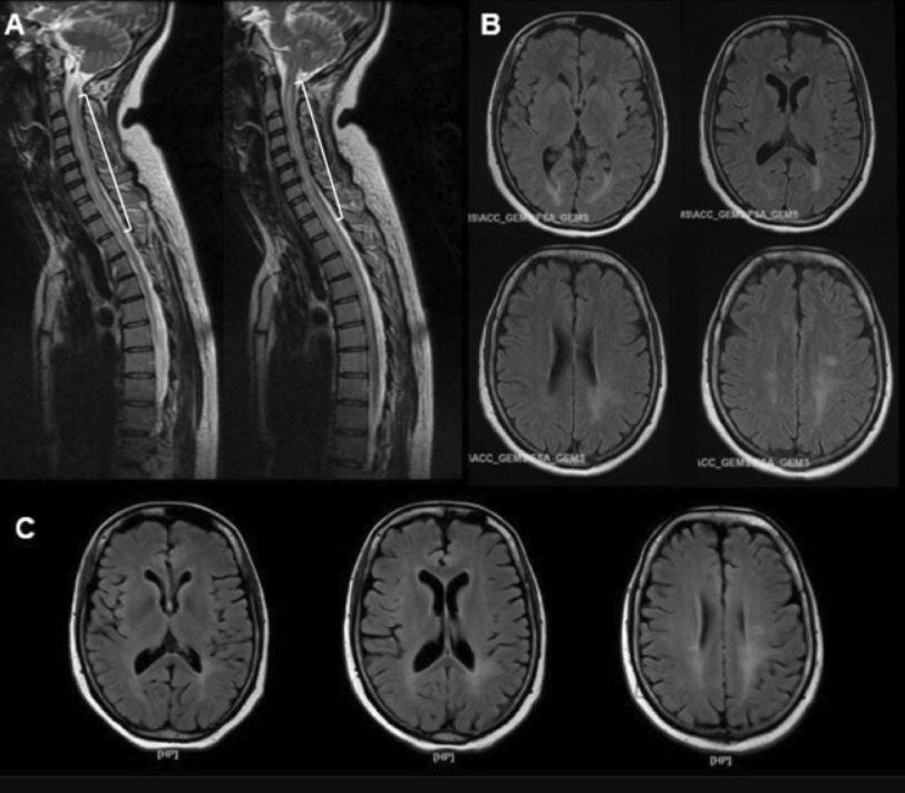 Encephalomyelitis Treatment