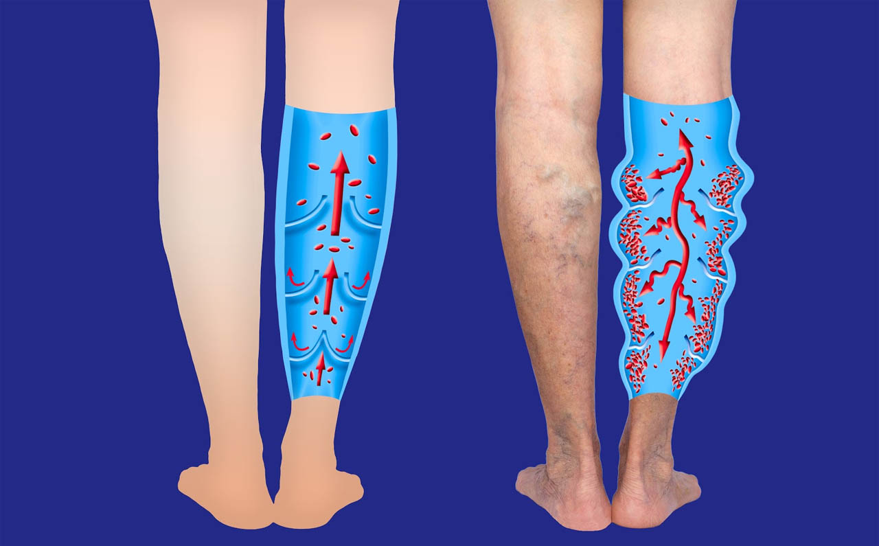 Endovenous Laser Treatment