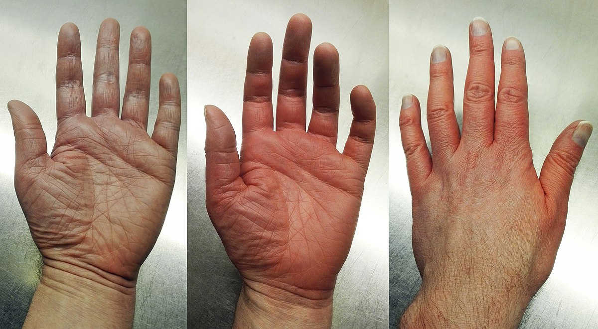 Erythromelalgia Treatment