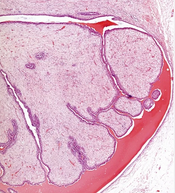 Fibroadenoma Diagnosis