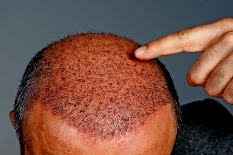 Hair Transplant Procedure