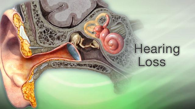 Hearing Loss Disease Treatment Drug