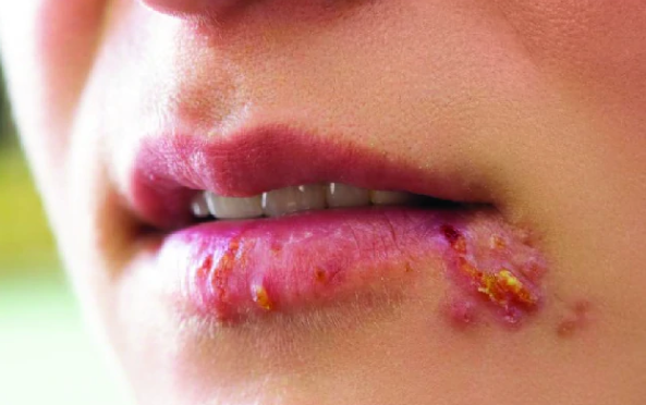 Herpes Simplex Virus Infection Treatment