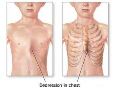 Homocystinuria