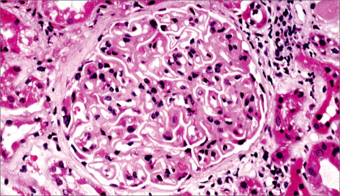 Idiopathic Membranous Nephropathy