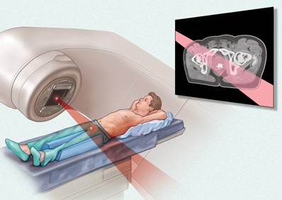 Internal Beam Radiotherapy