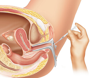 Intrauterine Insemination (IUI) Treatment