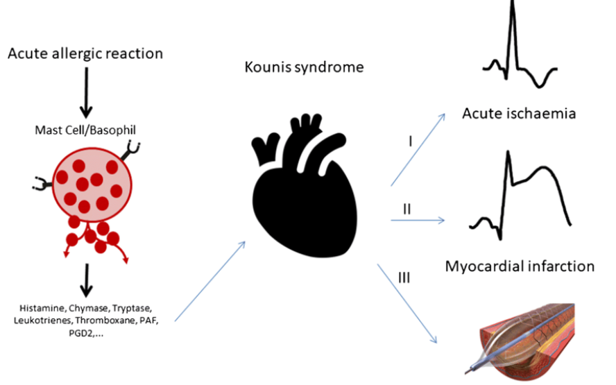 Kounis Syndrome Treatment