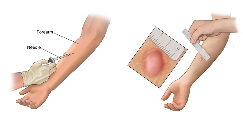 Latent Tuberculosis Infection Screening Test