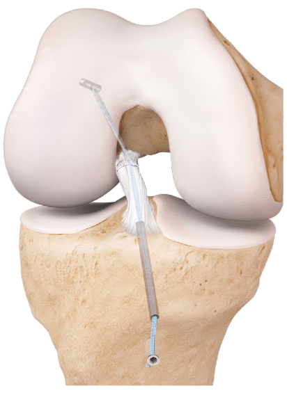 Ligament Augmentation