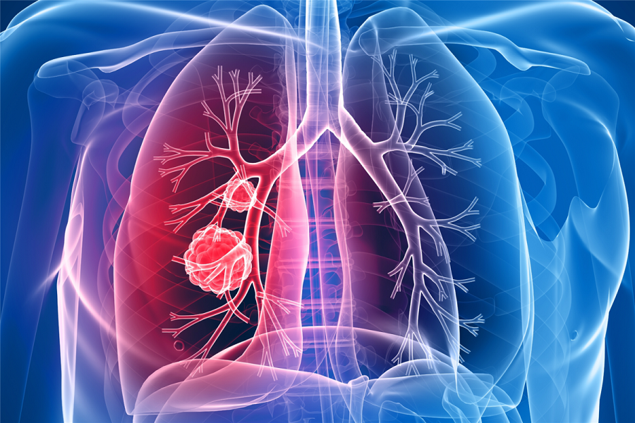 Lung Cancer Genomic Testing