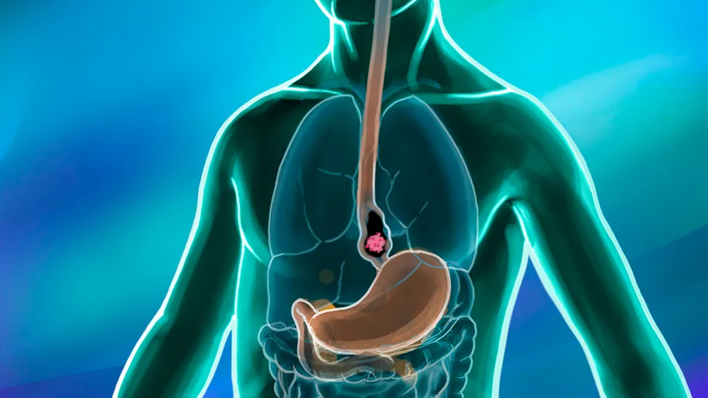 Medical Molecular Testing for Esophageal Cancer