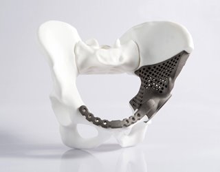 3D Printing in Orthopedics