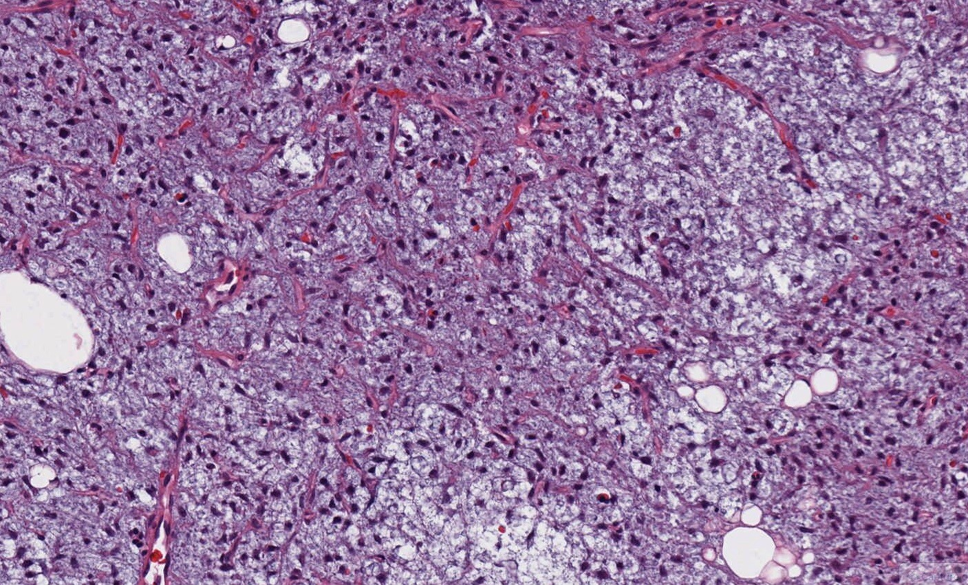 Myxoid Round Cell Liposarcoma Drug