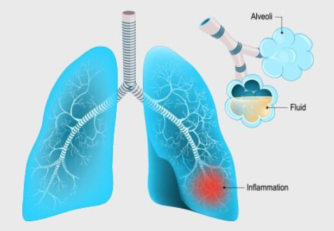 Respiratory Tract infections