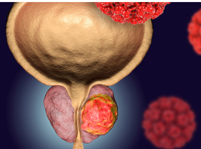 Castration-Resistant Prostate Cancer