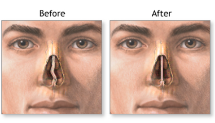 Septoplasty