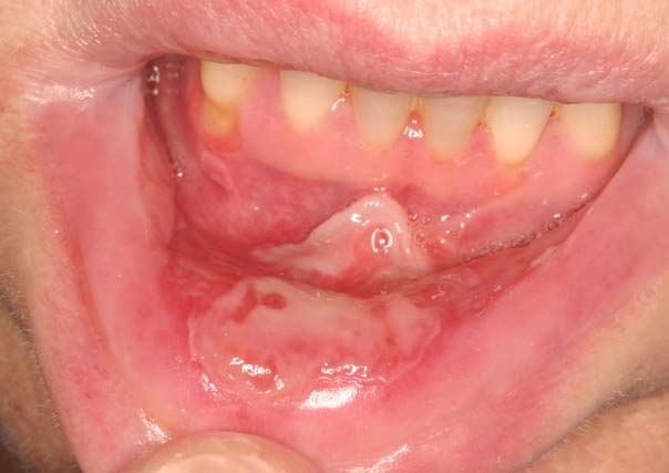 Severe Oral Mucositis Treatment