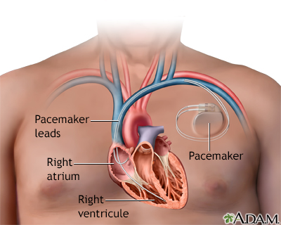 Sick Sinus Syndrome Treatment