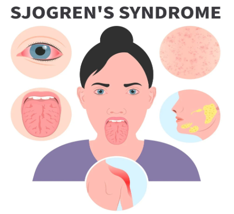 Sjogren's Syndrome