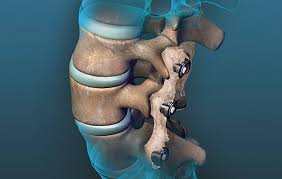 Spine Fusion Solutions