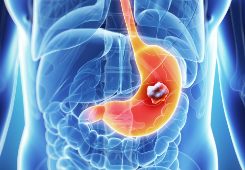 Stomach Cancer Drug Therapy