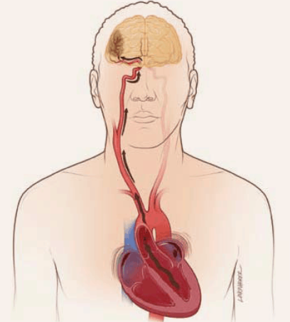 Stroke Prevention in Atrial Fibrillation Treatment